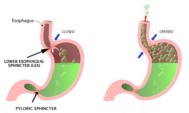 Is gerd the same as acid reflux