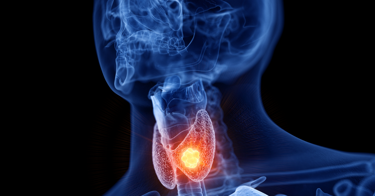 Thyroid Nodules