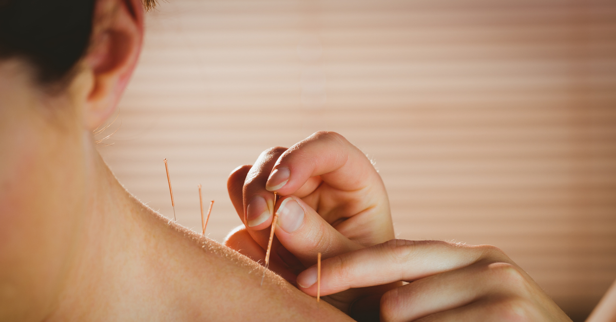 Woman getting acupuncture