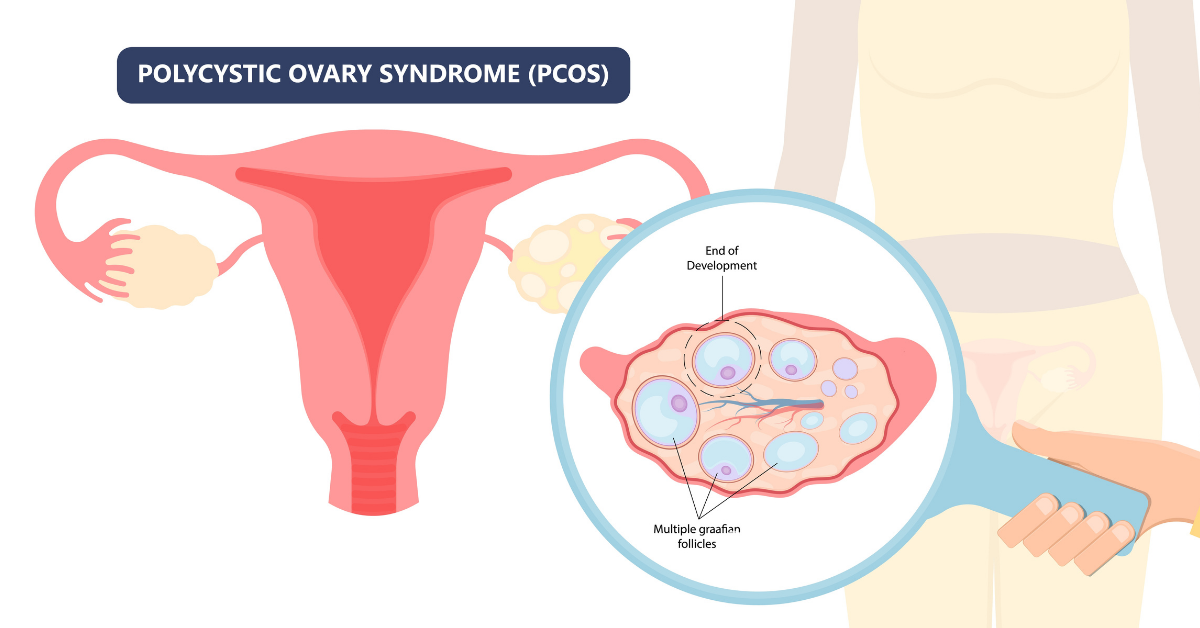 Polycystic Ovary Syndrome (PCOS) diagram
